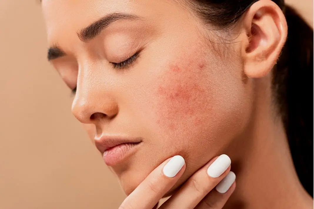 How To Get Rid Of Dark Spots On Face Dermatologist