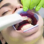 Teeth straighteners